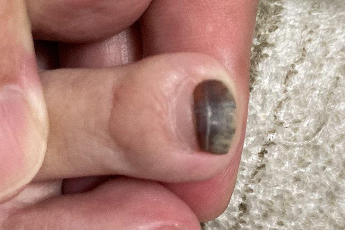 My toenail about 4 months after the injury. The new nail has grown 2 mm at the base, and the black part is being pushed toward the tip.