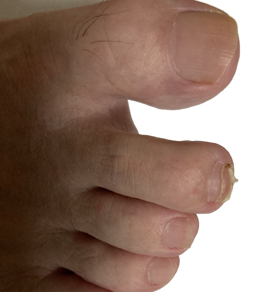 My second toe after the black nail came off. A new nail is growing underneath, and pieces of the old nail remain at the tip.